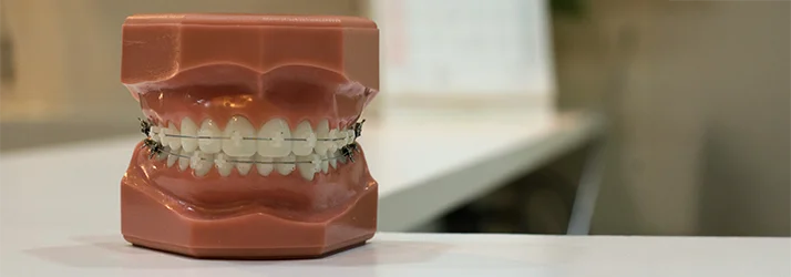 FC – Clear Braces at Matthew Jones Orthodontics in Gilbert AZ